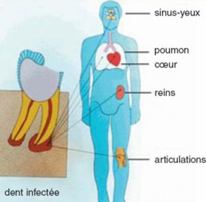 complications du granulome